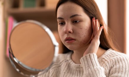 7 Home Remedies for Dark Spots and Skin Pigmentation