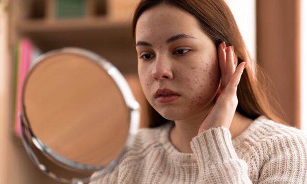 7 Home Remedies for Dark Spots and Skin Pigmentation