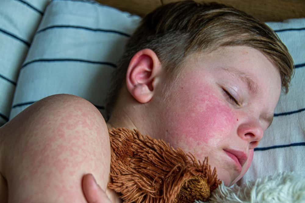 Early signs and symptoms of measles in children